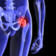 How to avoid hip surgery